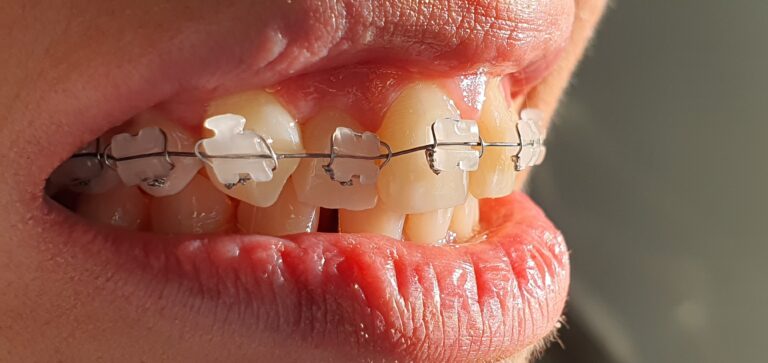 Teeth Alignment