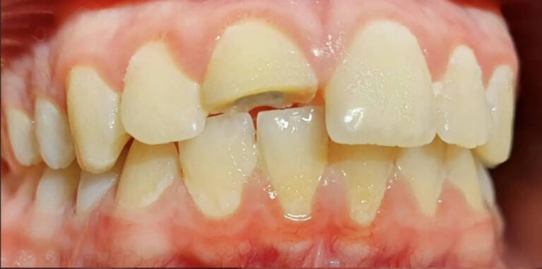 Teeth Implants